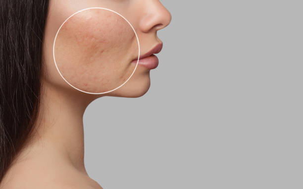 🌿 Acne Face Treatment at Home – Ghar Ke Nuskhe for Clear Skin
