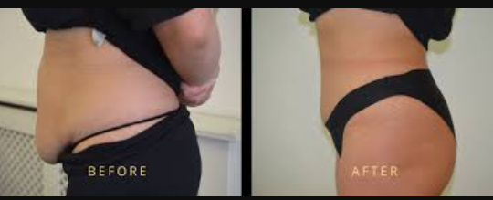 C-Section Belly Fat Remove Guide