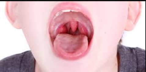 Tonsils Infection – Desi Nuskhe | Ghar Par Asaan Ilaj