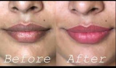 Lip Darkening Remove Routine | 7 Din Me Visible Results
