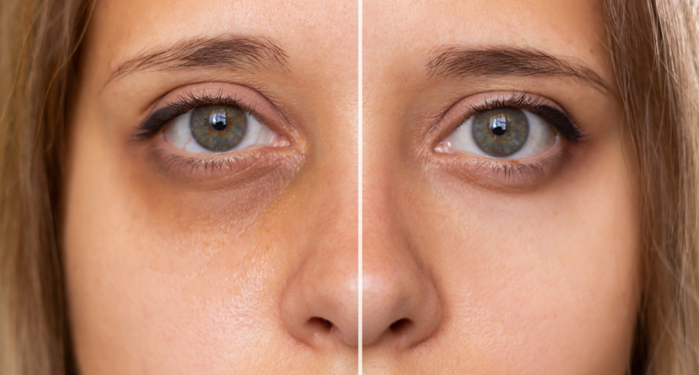 Under-Eye Dark Circles Herbal Solution – Natural & Safe Routine