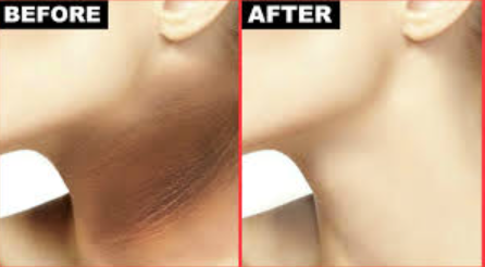 Dark Neck Treatment – 3 Weeks