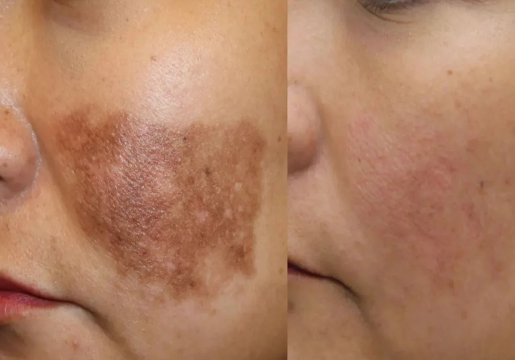 Pigmentation Remove With 1 Serum