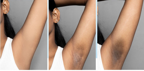 Underarm Pigmentation Treatment – Fast & Safe Lightening Routine