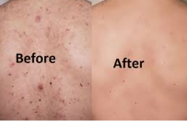 Back Acne Treatment – Complete Guide for Clear & Smooth Skin