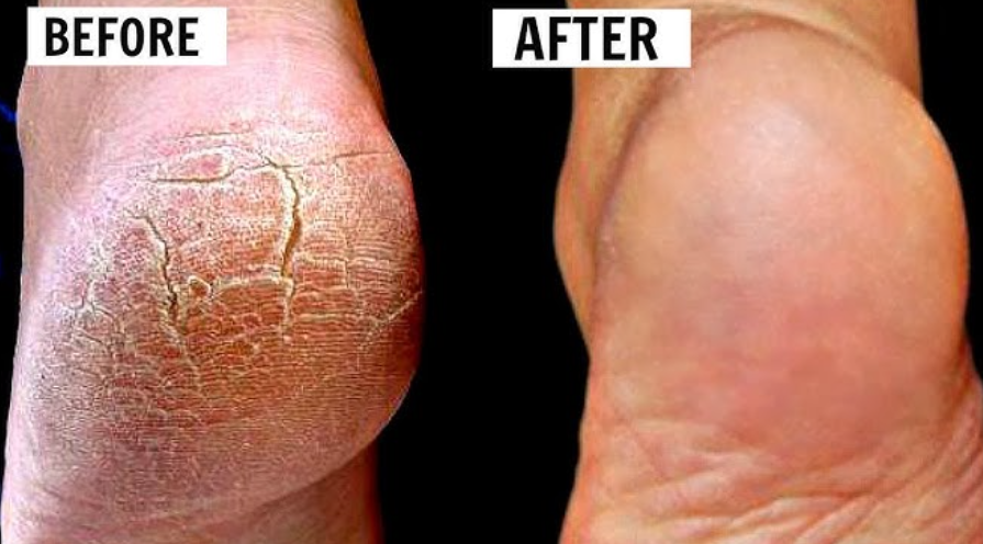 👣 Foot Cracks Healing Routine