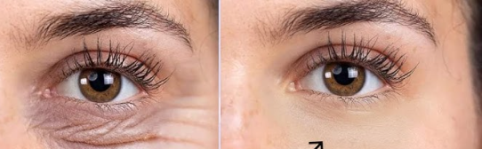 Under Eye Wrinkles Removal Tips