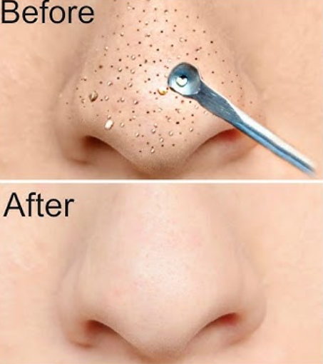 Blackheads Remove at Home – Instant Results