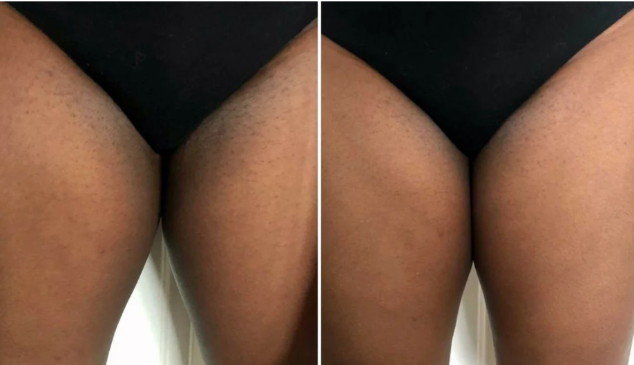 Under Legs Pigmentation & Dark Inner Thigh Whitening Guide