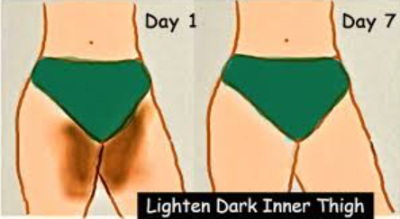 Dark Inner Thigh Whitening in 7 Days