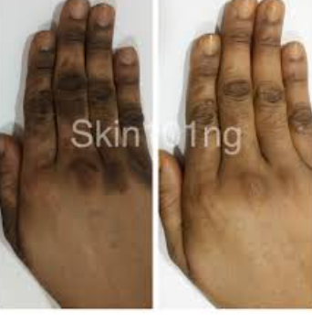 Dark Knuckles Treatment for Men