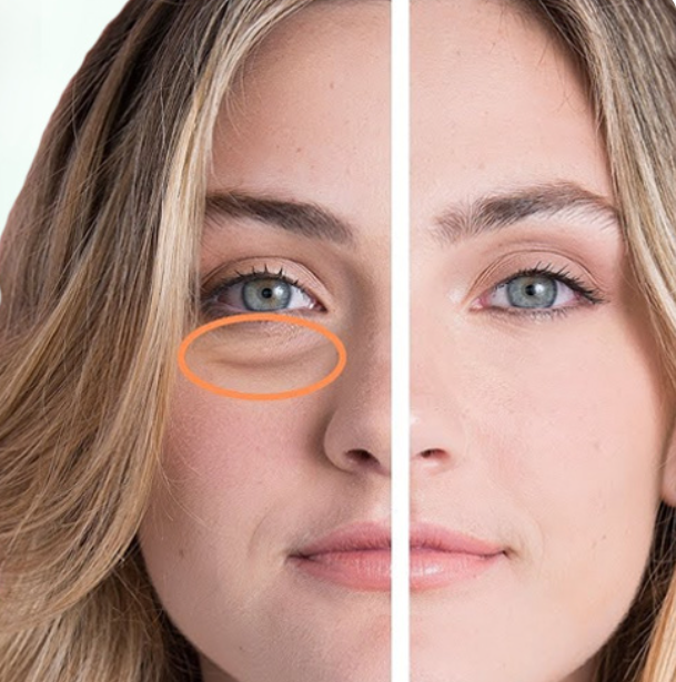 Puffy Eyes Treatment