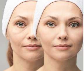 Saggy Under Eye Skin Treatment