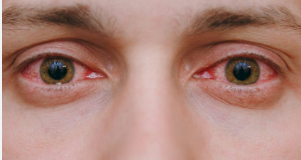 Pollution Effects on Eyes