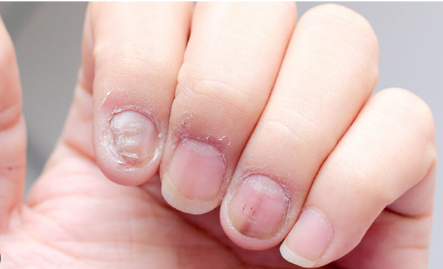 Fungal Nail Infection Treatment